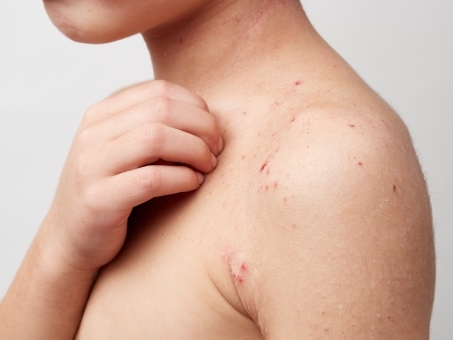 大人になってから再燃するケースが増えているアトピー性皮膚炎