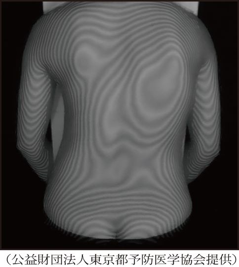 脊柱側弯症のモアレ検査の画像例