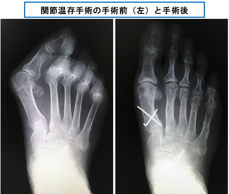関節温存手術前後のレントゲン写真（「足のクリニック表参道」提供）