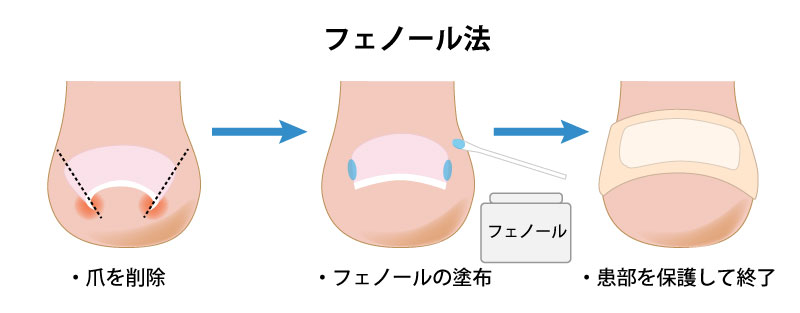 日本で最も普及している手術方法