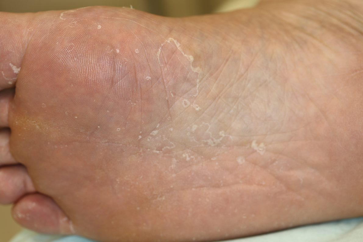 足の裏全体の皮がむけたように見える足水虫