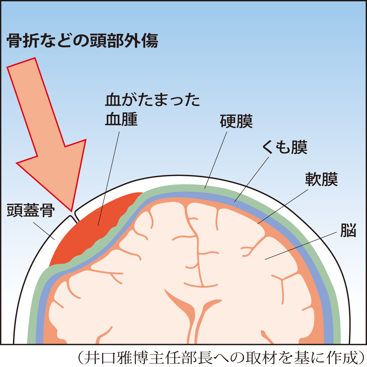 硬膜と頭蓋骨の間に血腫ができる急性硬膜外血腫