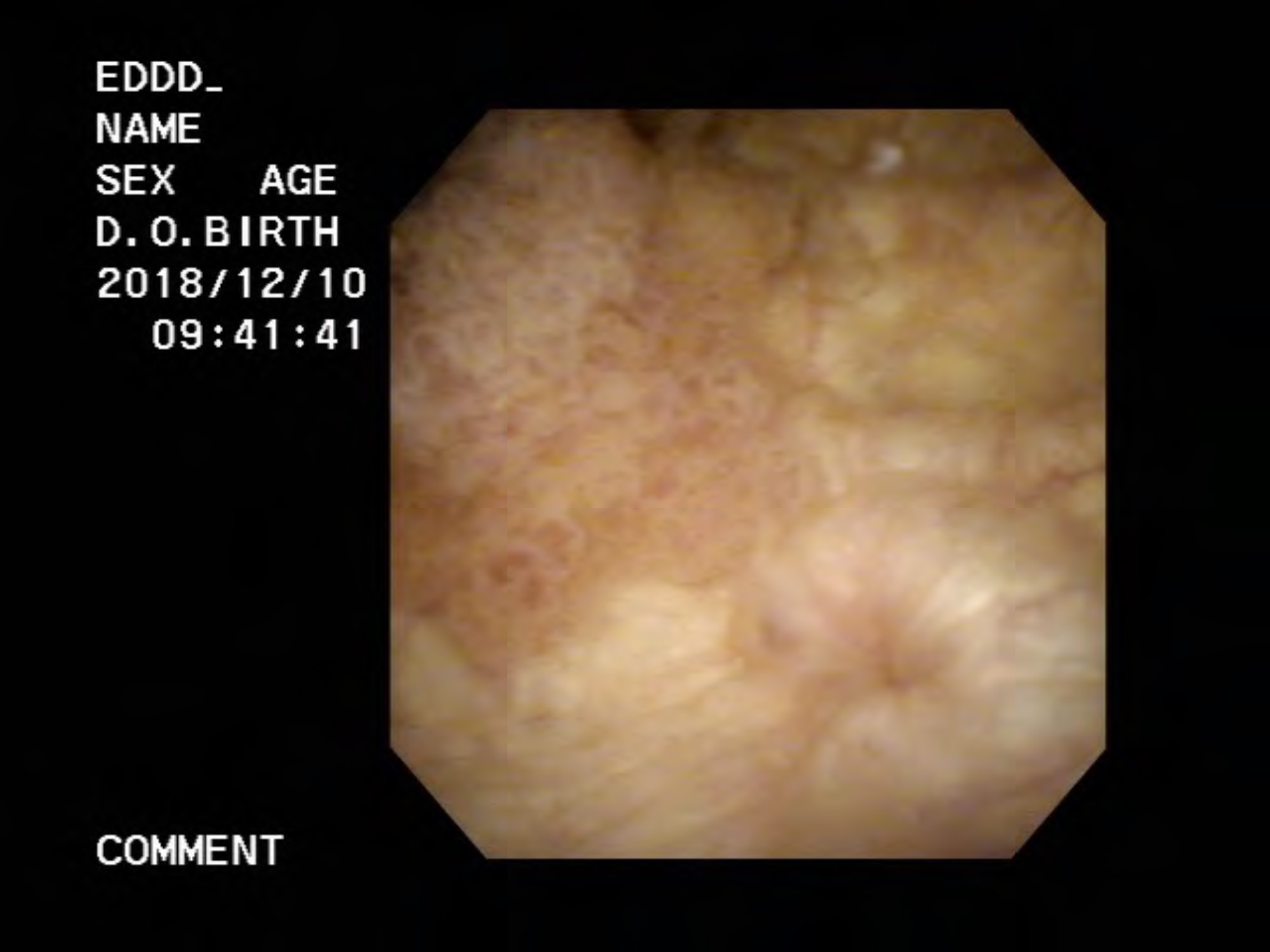 膀胱内の内視鏡の画像に浮かび上がった腫瘍部（左部分）