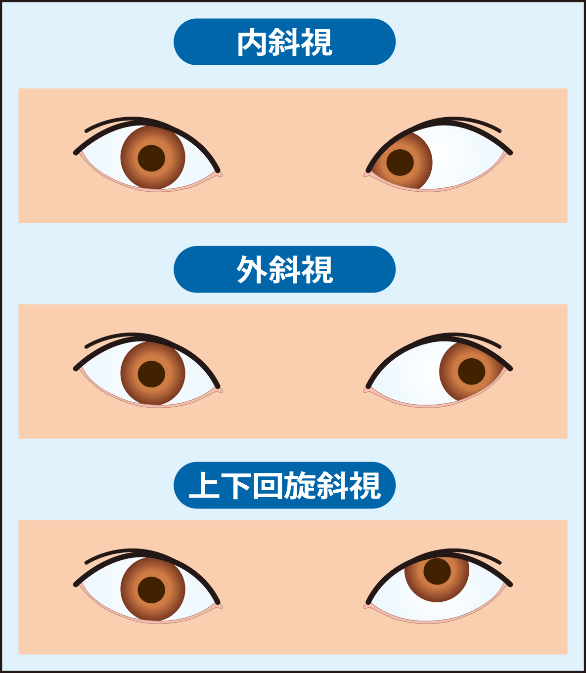 斜視の主な種類