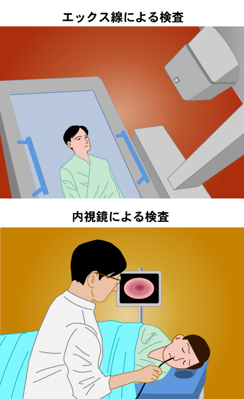 胃がん検診にはバリウムを使ったエックス線画像検査と内視鏡検査がある