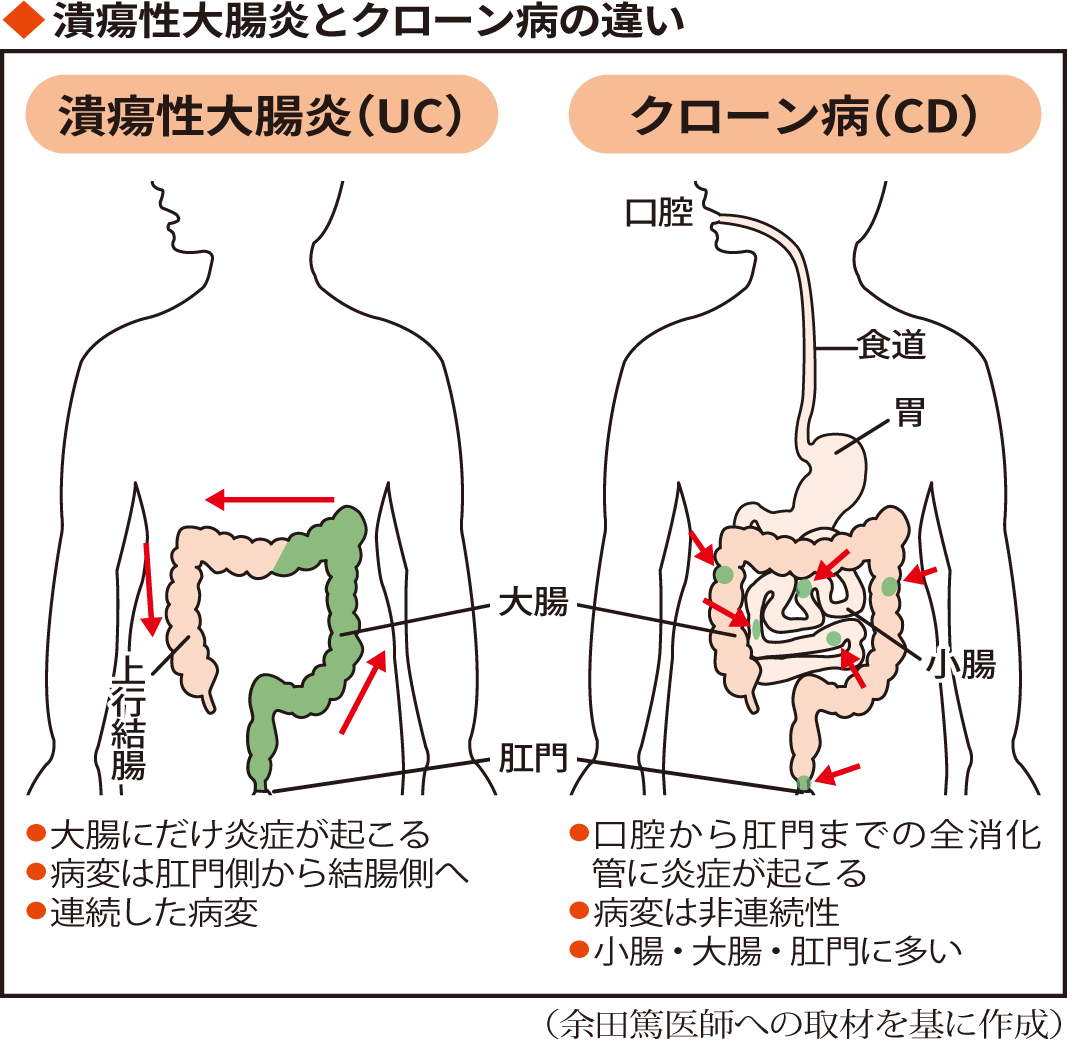 潰瘍性大腸炎とクローン病では炎症が起こる部位が異なる