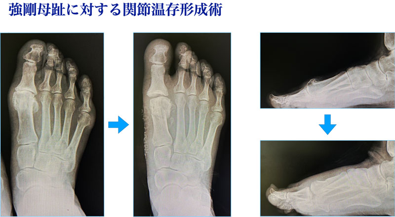 強剛母趾の関節温存形成術の手術前と手術後の状態を示したレントゲン写真（「足のクリニック表参道」提供）