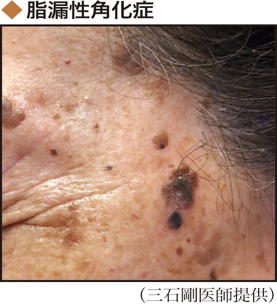 肌の老化現象の一つで、皮膚がんの心配はない
