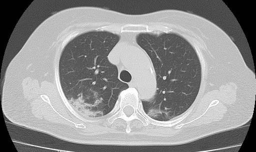 異常がない状態の肺のＣＴ画像