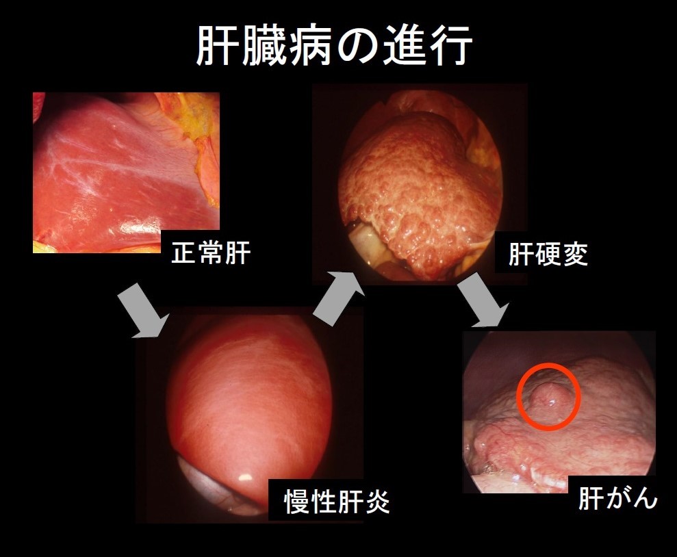 アストラゼネカ肝がんメディアセミナー資料より