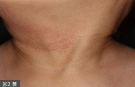 乳児期。首のしわに赤みが目立つ＝九州大学皮膚科ウェブサイトより