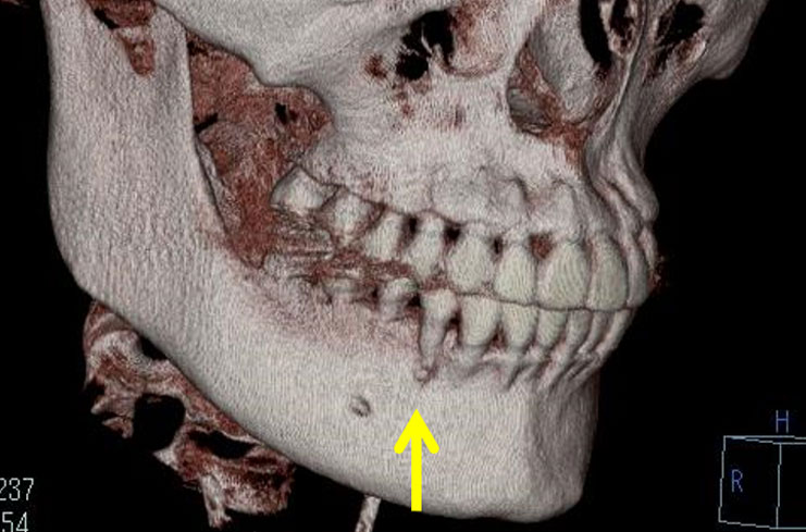 骨から出てしまった下顎の第１小臼歯