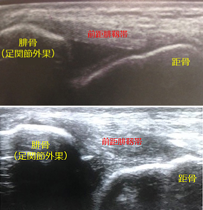 正常な前距腓靭帯（上）と損傷した前距腓靭帯（下）のエコー画像。前距腓靭帯は足関節外側靭帯のひとつで、足首を内側にひねった捻挫で損傷することが多い。損傷した靭帯のエコー画像は、輪郭が不明瞭になっている（足のクリニック表参道提供）