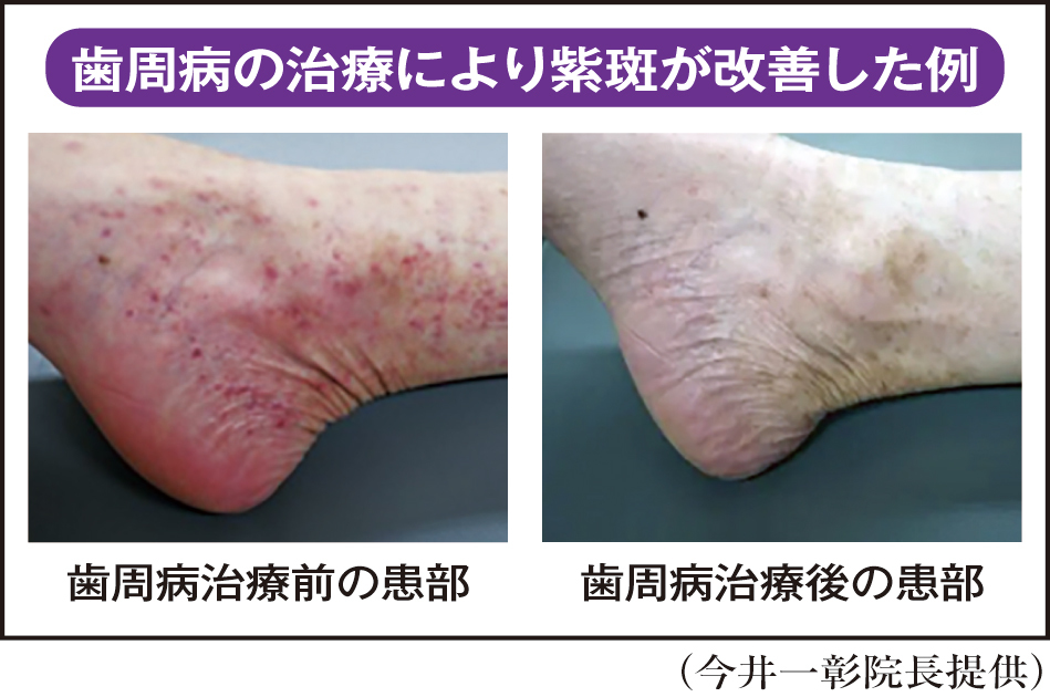 足に赤紫色のあざが表れる―慢性色素性紫斑歯周病や喉の炎症が原因に