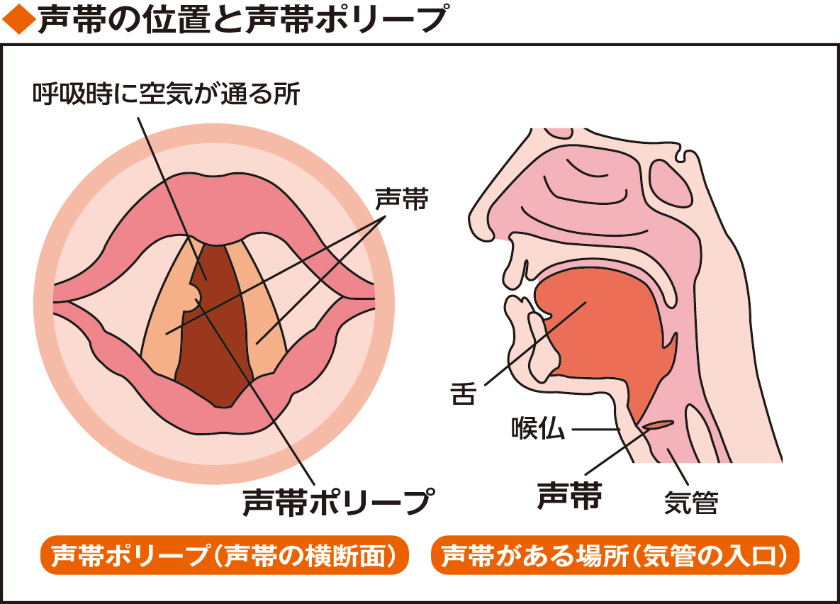 声帯の位置と声帯ポリープ