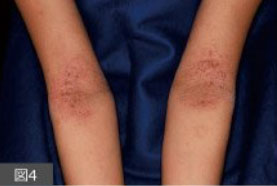 幼少時期。肘のくぼみに発疹が見られる＝九州大学皮膚科ウェブサイトより