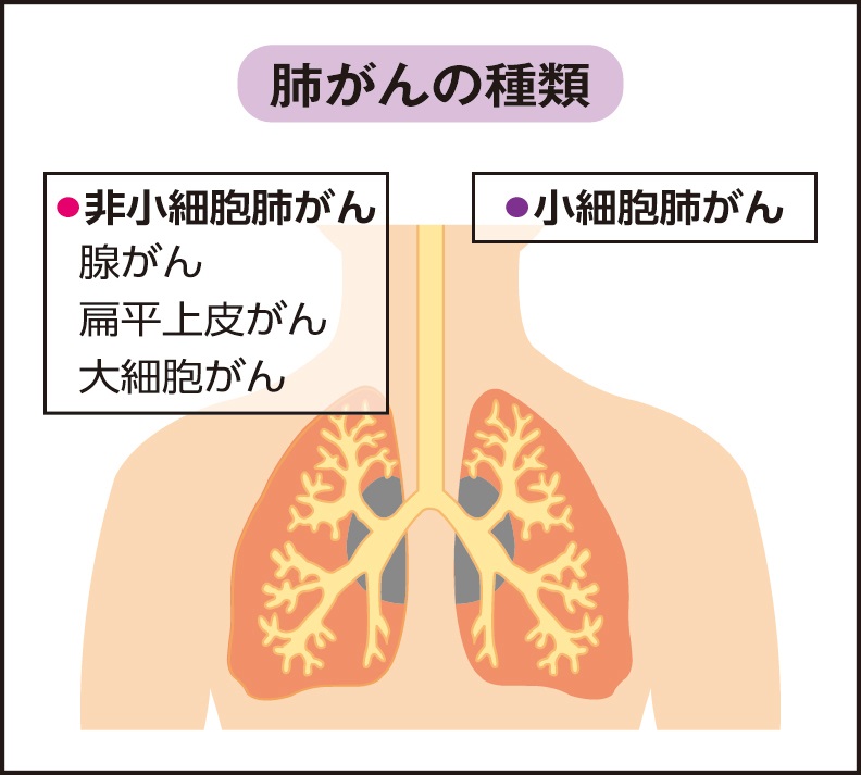 肺がんの多くが非小細胞がん
