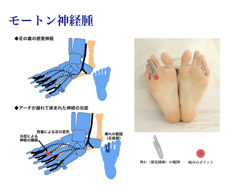 薬指 足 の 指 痛い 足先に針で刺されたような痛みの原因とは？