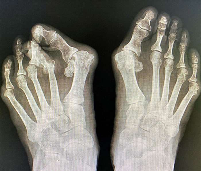 手術前の足のレントゲン写真。外反母趾がかなりの重症であることが分かる（「足のクリニック表参道」提供）