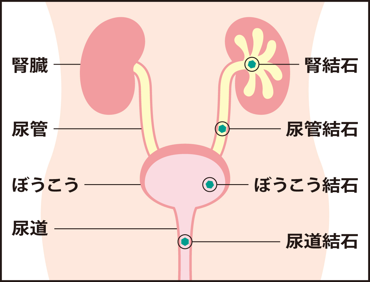 尿路結石とは