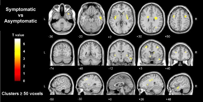 脳内鉄蓄積量の全脳解析結果