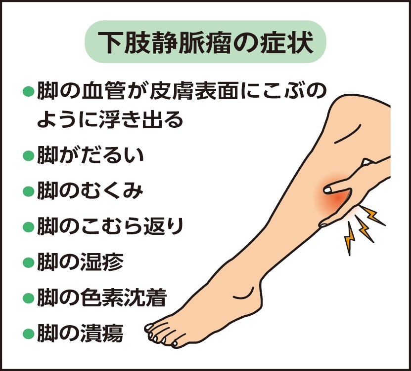 下肢静脈瘤の症状