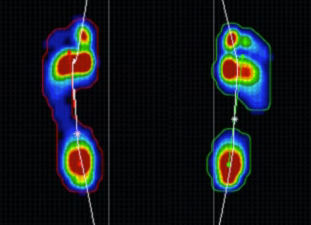 足底圧測定装置で撮影した正常歩行の様子（「足のクリニック表参道」提供）