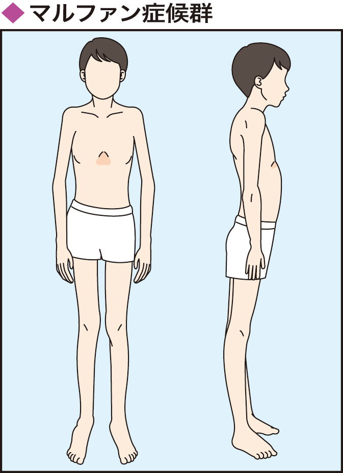 背が高い、背骨が曲がるなど特徴的な体形が見られるマルファン症候群