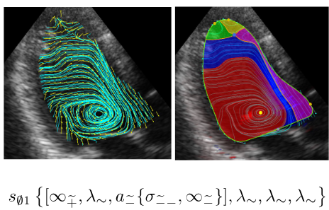 図1（左上）心エコーVFMのデータ  （右上）TFD解析によって得られた渦血流領域（赤い領域） （下）TFD解析で得られるCOT表現文字列