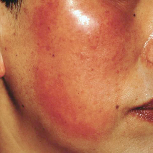皮膚に境のはっきりした赤色の腫れが現れる