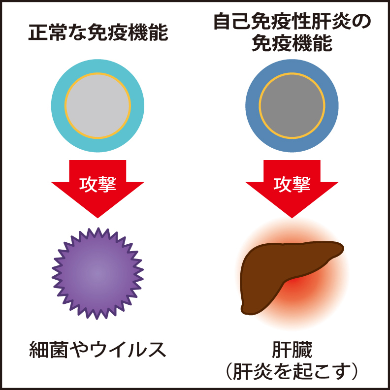 正常な免疫機能（左）と自己免疫性肝炎