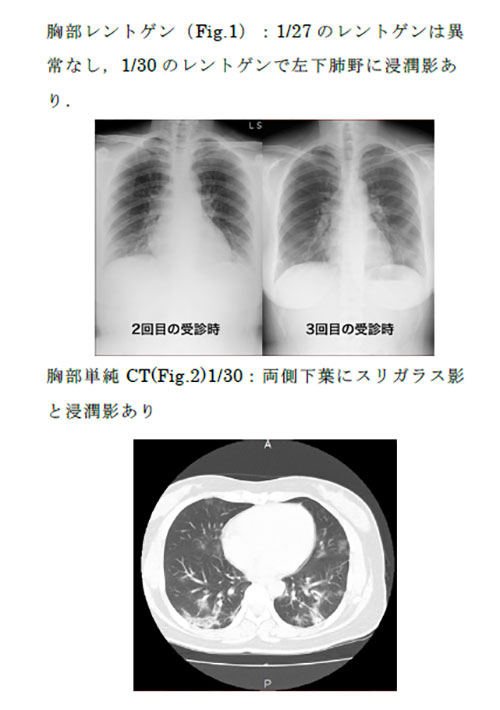 ３０代女性患者胸部のレントゲン（上）とＣＴ写真
