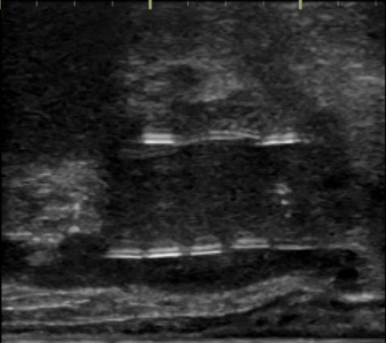 経直腸エコー（超音波）で前立腺を縦断像で見ている画像。中心の上下に何個か連なっている白く細長いものがヨウ素125という放射線を密封しているカプセル