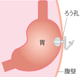 胃ろうは胃に直接栄養を送る