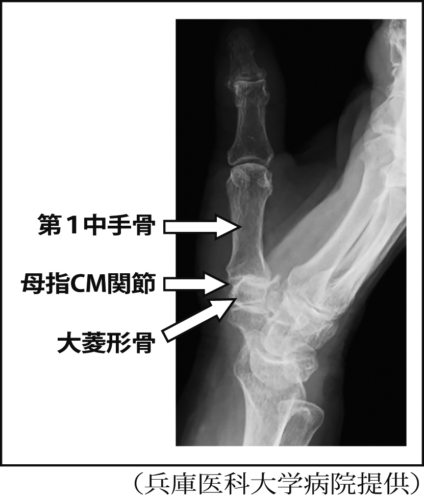 母指ＣＭ関節では関節がずれるケースも