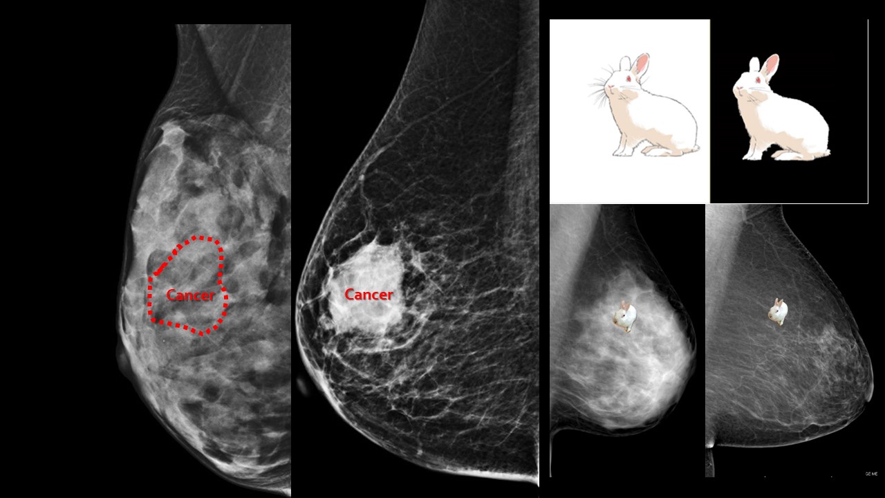 乳がんの見え方の比較。3センチの乳がん（Cancer）は左の画像（高濃度乳房）では全く見えないが、右の画像（非高濃度乳房）だとはっきり見える
