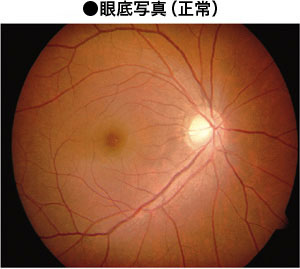 眼底検査 家庭の医学 時事メディカル 時事通信の医療ニュースサイト