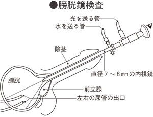 内視鏡検査 膀胱鏡 尿道鏡 腎盂尿管鏡 家庭の医学 時事メディカル 時事通信の医療ニュースサイト