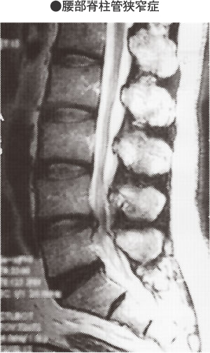 腰部脊柱管狭窄症 ようぶせきちゅうかんきょうさくしょう 家庭の医学 時事メディカル 時事通信の医療ニュースサイト