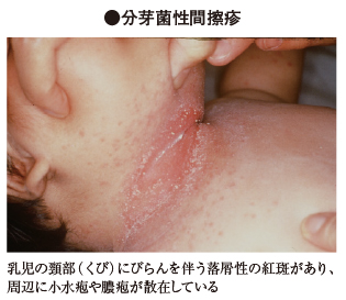 せつ 看護 らく 写真でみる川崎病の症状と診断－どのような発疹が現れる？