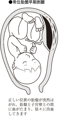 位 早期 常 剥離 胎盤