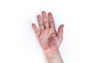 日本人の掌蹠膿疱症にアプレミラストが有効