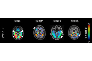 中高年のうつ病、認知症と関連か＝脳内に原因物質蓄積―量研機構