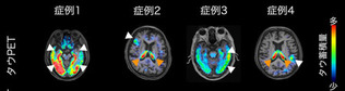 40歳以降にうつ病などの気分障害を発症した患者の脳のPET画像。白い矢印は病的なタウたんぱく質の蓄積、オレンジは健常者にも見られる蓄積(量子科学研究開発機構提供)