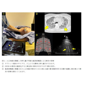 人工知能を搭載した持ち運び可能な超音波機器による新型コロナ肺炎診断
