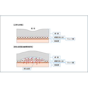 既存治療に抵抗性の新生血管型加齢黄斑変性におけるヒト(同種)皮下脂肪組織由来間葉系幹細胞シート（PAL-222）移植の第I/IIa相臨床試験（治験）（試験名：PRESERVE試験）の治験開始について