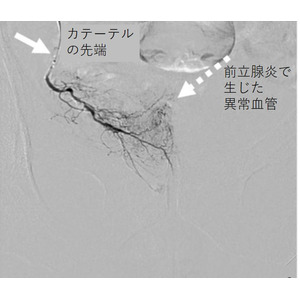 男性の難敵、慢性前立腺炎への新しい治療法を第111回日本泌尿器科学会にて発表