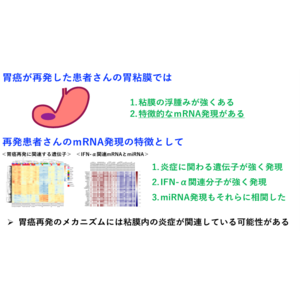 早期胃癌の異所性異時性再発の原因の一端を解明　ピロリ菌除菌後の背景胃粘膜の炎症の継続が関与