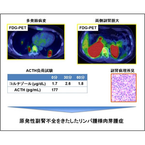 原発性副腎不全をきたしたリンパ腫様肉芽腫症を報告～日本で初めて、世界でも数件しか報告されていない希少な病態～