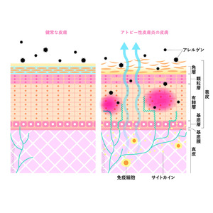 アトピー性皮膚炎治療に新たな知見！　世界最小＊1「ナノサイズ微細水粒子AIR（アイル）」がアトピー性皮膚炎の症状を緩和する可能性